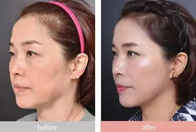 韩国vg整形外科,面部拉皮手术前后对比日记公布!