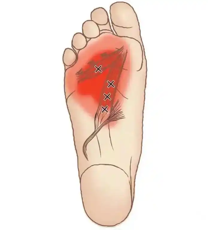 足底筋膜炎也困扰了很多体育生,部分体育生存在扁平足,加上高强 - 抖