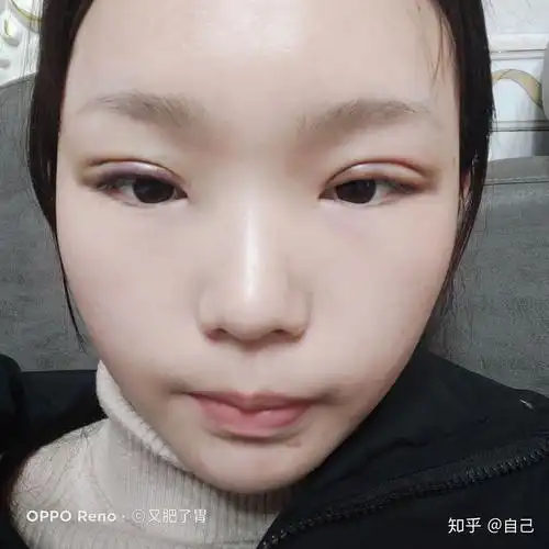 帮我看看我的埋线双眼皮失败了吗