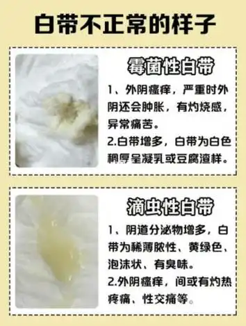 正常白带是什么样子的图片异常白带各种症状图片大全
