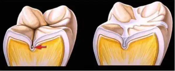 第三阶段:13岁的第二恒磨牙