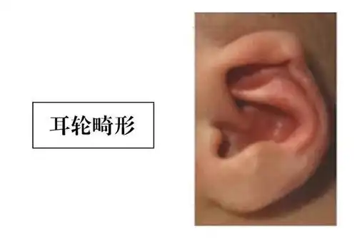 耳轮畸形stahls耳畸形是一种较为罕见的先天性耳廓畸形,有三种显著的