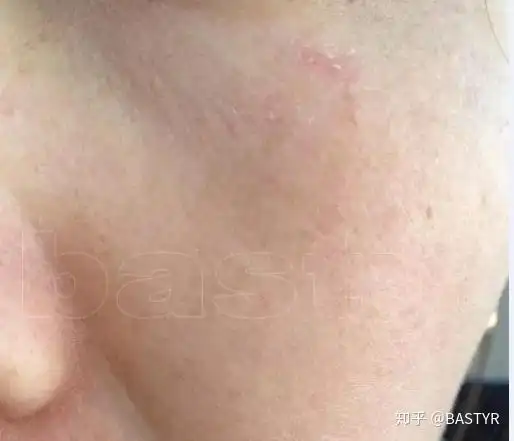 1,受损后皮肤干燥,满是干纹的皮肤,健全的皮脂膜可让皮肤保持润滑和