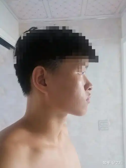 这种侧脸到底该怎么办啊简直丑爆啊是嘴凸吗