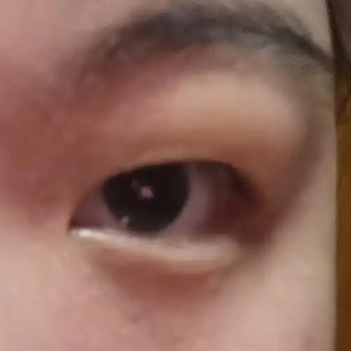 知道自己眼皮肿但没想到这么肿