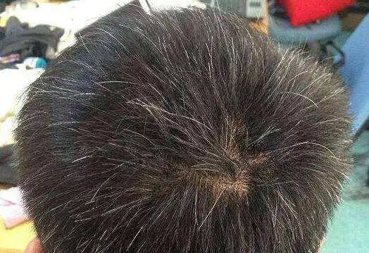 白发长在哪里,病或从哪出?长在前额两鬓和后脑勺,或说明什么?