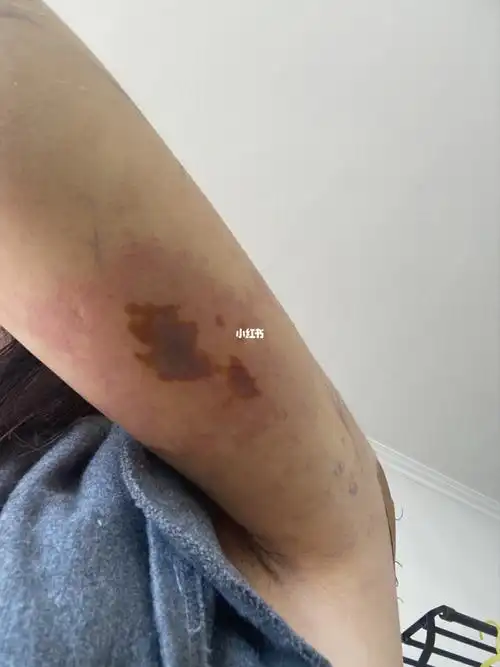 担心得睡不着_减肥_抽脂减肥_减肥_减肥医药