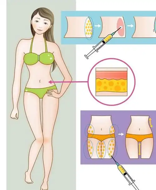 16个常识带你正确认识抽脂手术,避免走向"减肥"误区