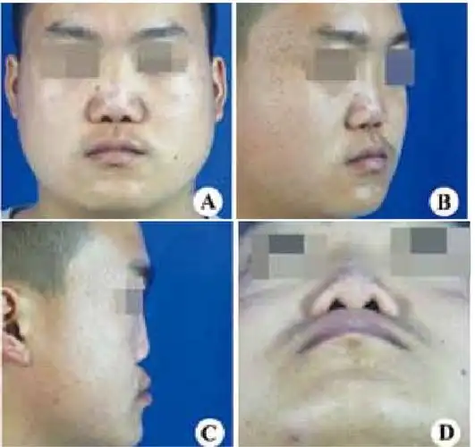 自体肋软骨联合膨体聚四氟乙烯治疗binder综合征一例