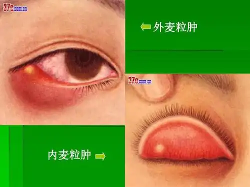 4眼睑病5泪器病6眼表病ppt