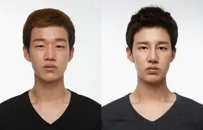 男生割双眼皮前后对比图