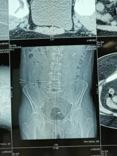 射频热凝臭氧消融术联合骶管裂孔置管椎间盘胶原酶化学溶解术治疗腰椎