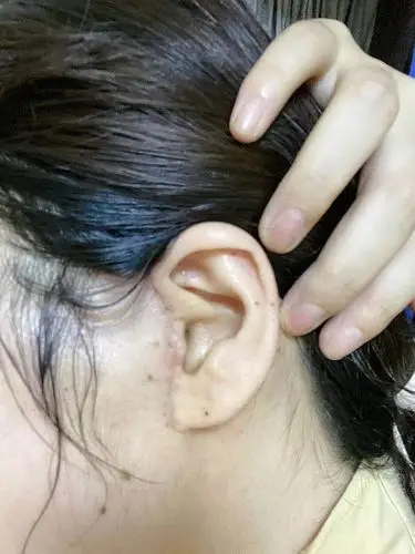 【小切口拉皮】第10天