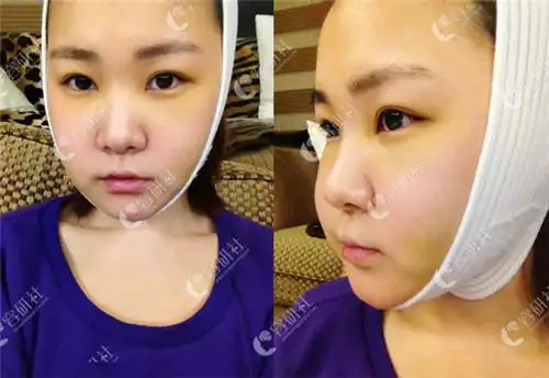 在韩国原辰整形医院做了下巴缩小手术长脸变甜美幼幼脸