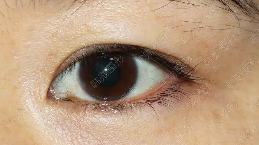 上睑皮肤松弛矫正的研究