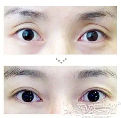 上眼皮填充脂肪对比照