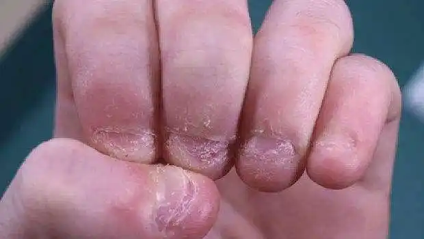 "啃指甲"的孩子,长大后难逃2个结局