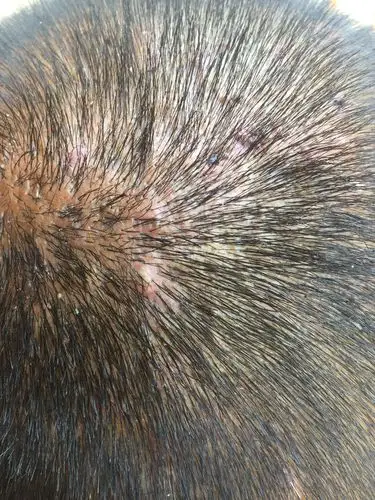 头皮起了一片红疙瘩,还有的有白泡,这是什么病!反复起,很痒!