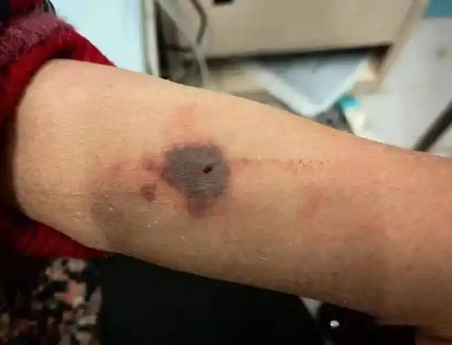 如图,患者心率快泵入美托洛尔,发生了药物外渗,看着像是皮肤坏死,周围