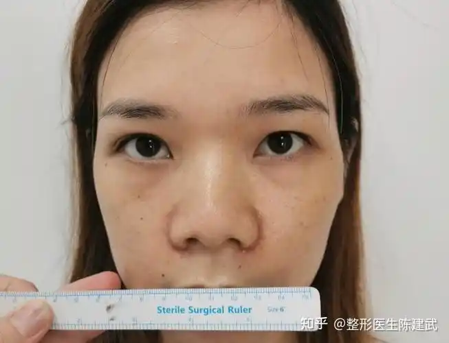 缩鼻翼后看起来精致了很多