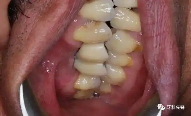 【病例】两颗种植牙种歪的病例补救