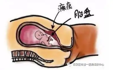 胎盘植入是什么鬼有那么可怕吗