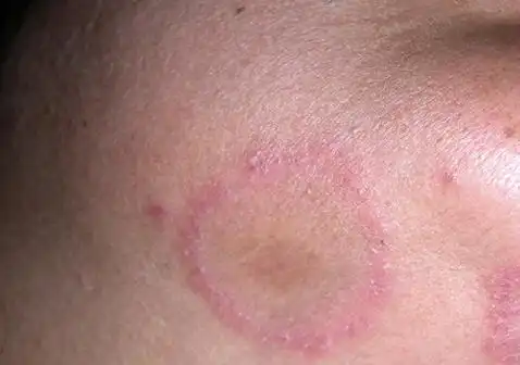 皮肤圆圈癣长什么样皮肤圆圈癣图片