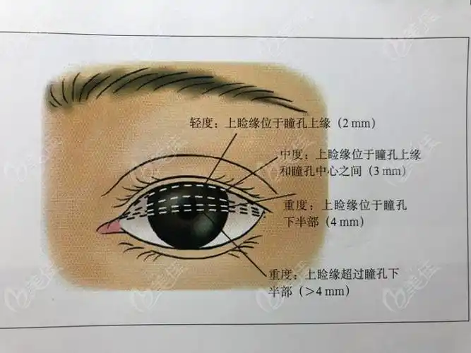 赶紧看上睑提肌矫正与cfs lm的区别是什么,别再说