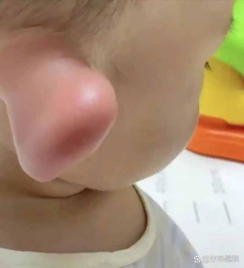 今天在医院里,看见一个小孩,他的耳朵大的出奇,是因为生病红肿了吗?