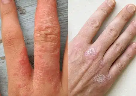 皮炎和癣的区别图片