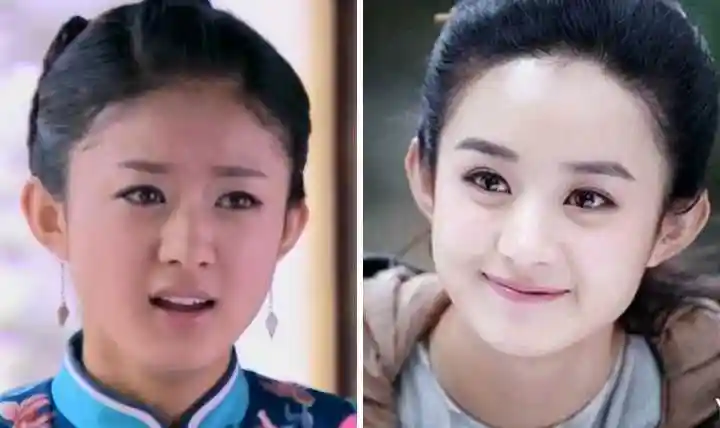 赵丽颖填充额头前能看到颞线