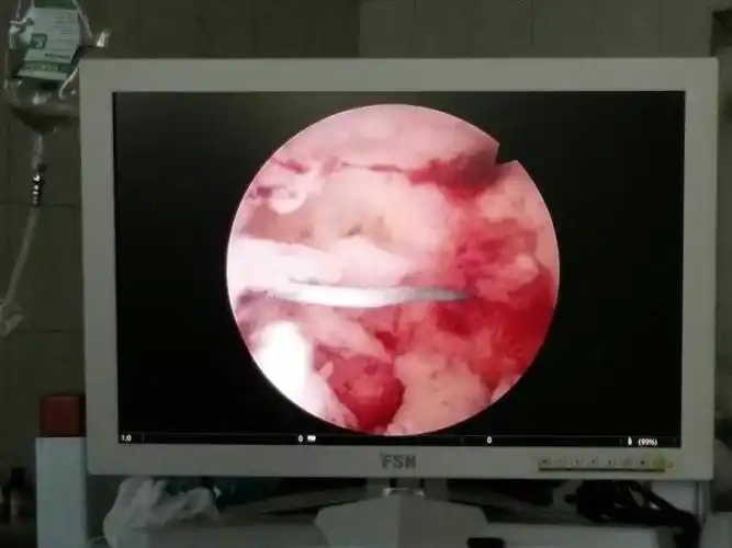 环嵌顿宫腔镜下取环