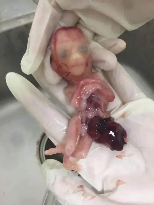 腹裂畸形引产后