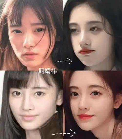 原创专业医美称鞠婧祎做了颧骨内推术后肌肉下垂脸不能做大动作