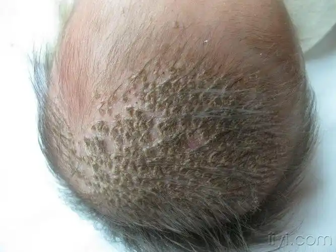 婴幼儿头部皮损脂溢性皮炎