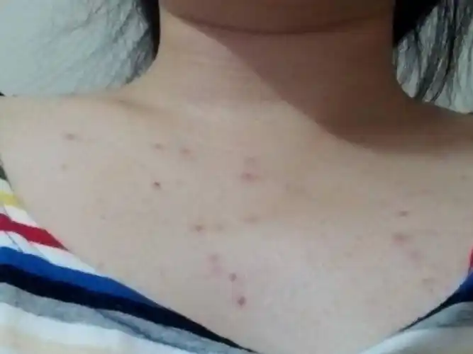 最近胸前长很多痘痘,请问是什么原因?