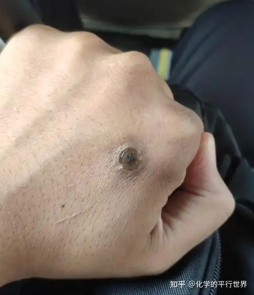 寻常疣&平常疣治疗过程&思考 - 知乎