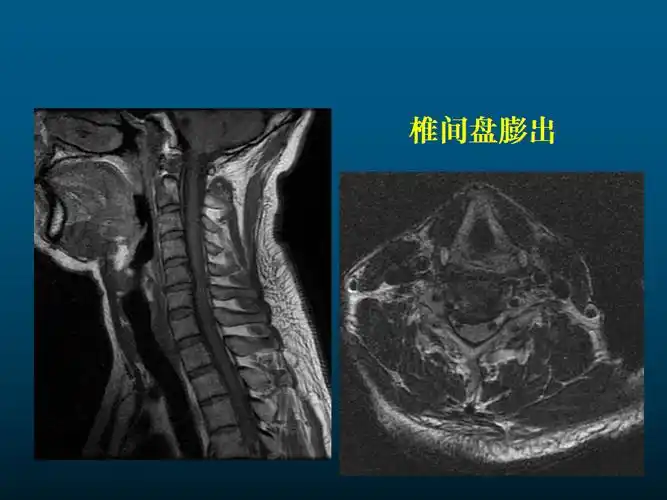 一篇课件详解颈椎病的mri诊断技巧
