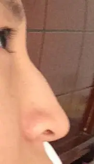 自从戴了眼镜以后,现在发现鼻子中间地方骨头突起怎么