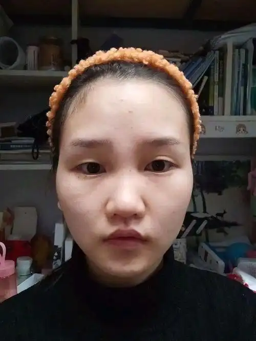 90针对颧骨低平和颧骨高耸问题#求看脸打卡可以考虑适当垫高,也就是