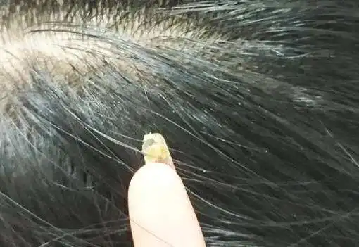 头螨一经发现数量就已破千万,多少人发根遭螨虫蚕食,2招来帮你_头皮