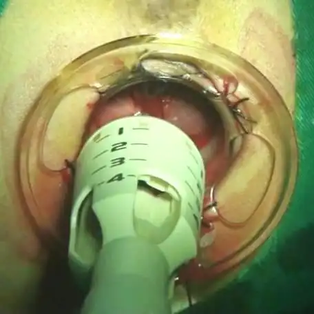 选择性痔上黏膜切除钉合术(环切)