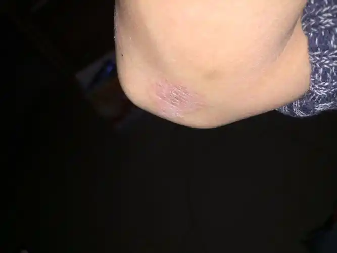 不传染,好像也没扩.