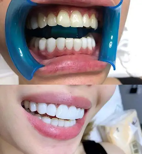 门牙缝隙大做贴面好吗?树脂贴面和瓷贴面哪个好?-医秀网