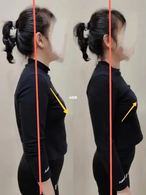 圆肩驼背调整一节课对比