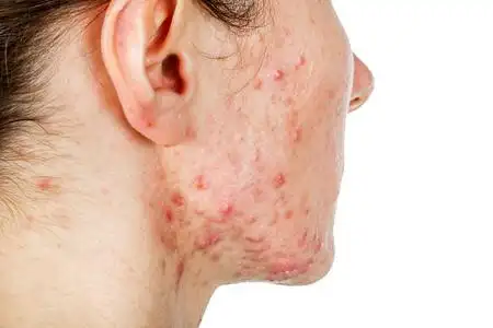 年轻女孩皮肤问题照片