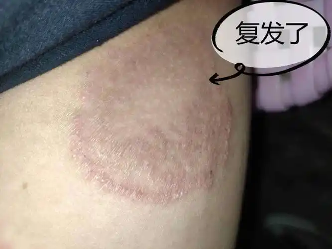 为什么股藓的人越来越多?4个坏习惯,或让股藓复发"翻倍"