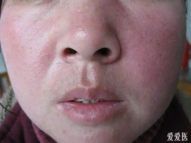 第一集肿胀型红斑狼疮这个病例有点意思围观一下看看你的诊断