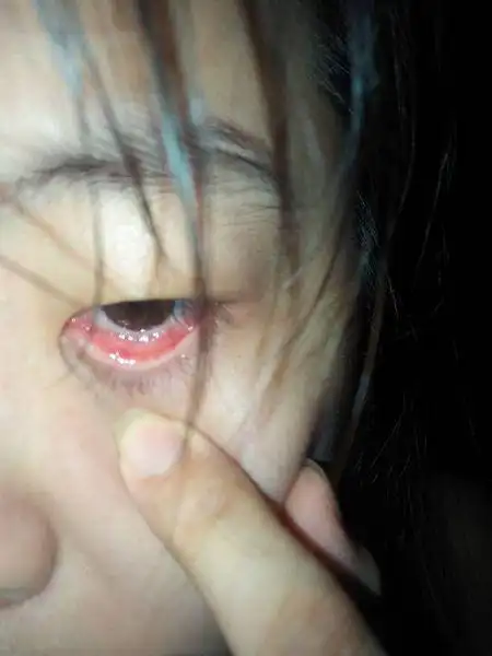 问:眼睛下眼睑好疼,还发红,上面有颗粒状凸起,内眼角结膜还发痒为什么