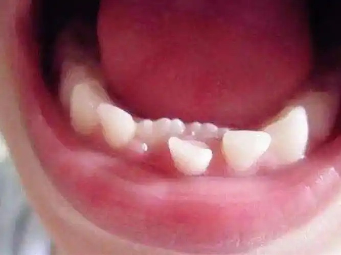 7岁娃长出了"双排牙",只因家长这个坏毛病,许多父母都中招了!